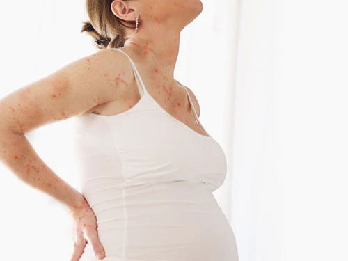 Nhiễm thủy đậu khi mang thai có nguy hiểm? ảnh 1